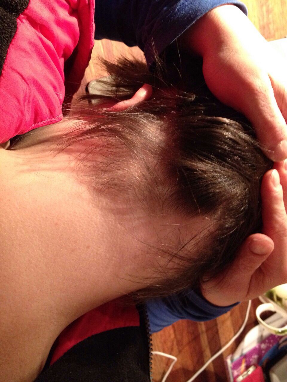 Haaruitval inhammen bij jongere  kale plekken